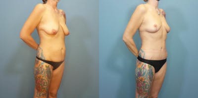 Massive Weight Loss/Body Lift Before & After Gallery - Patient 270315 - Image 2