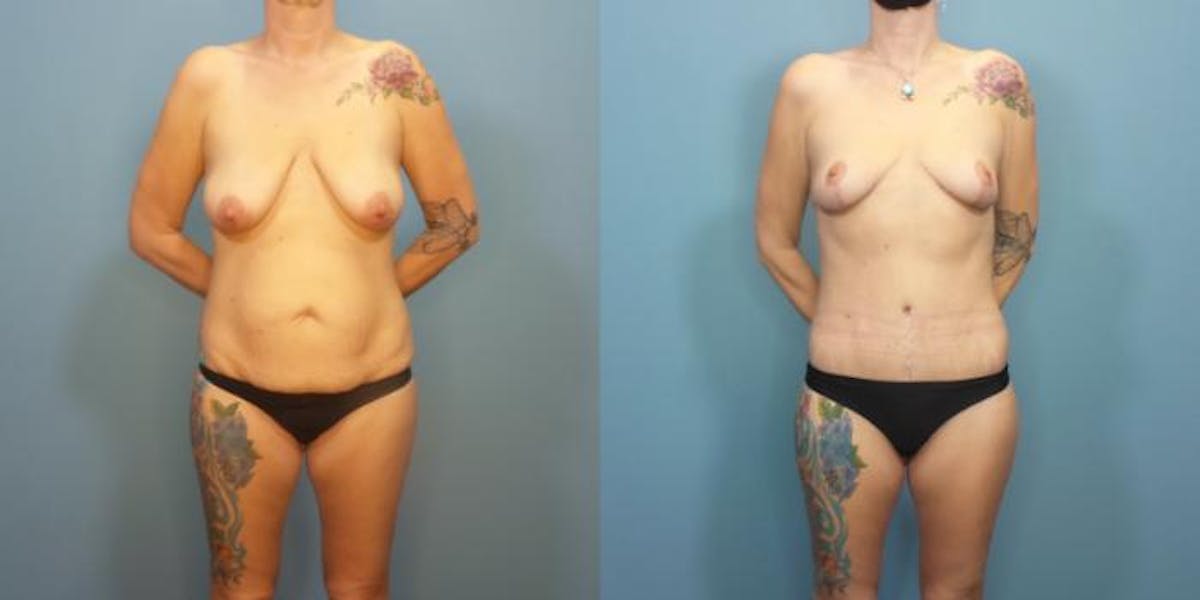Massive Weight Loss/Body Lift Before & After Gallery - Patient 270315 - Image 3
