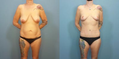 Massive Weight Loss/Body Lift Before & After Gallery - Patient 270315 - Image 3