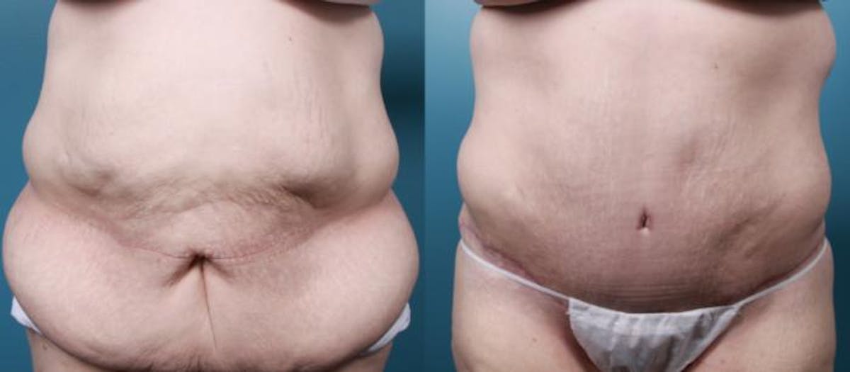 Massive Weight Loss/Body Lift Before & After Gallery - Patient 220272 - Image 1