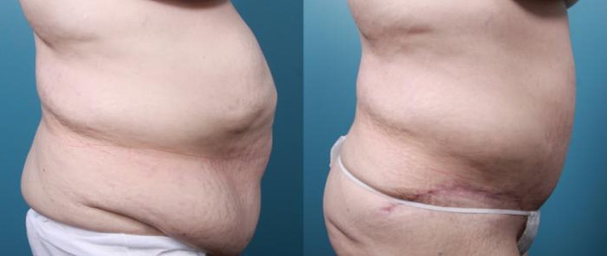 Massive Weight Loss/Body Lift Before & After Gallery - Patient 220272 - Image 2