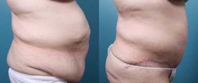 Massive Weight Loss/Body Lift Before & After Gallery - Patient 220272 - Image 2