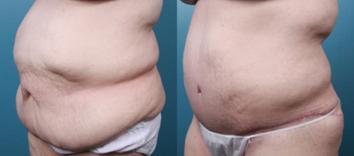 Massive Weight Loss/Body Lift Before & After Gallery - Patient 220272 - Image 3