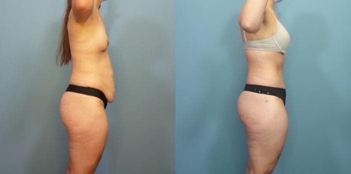 Massive Weight Loss/Body Lift Before & After Gallery - Patient 340220 - Image 1