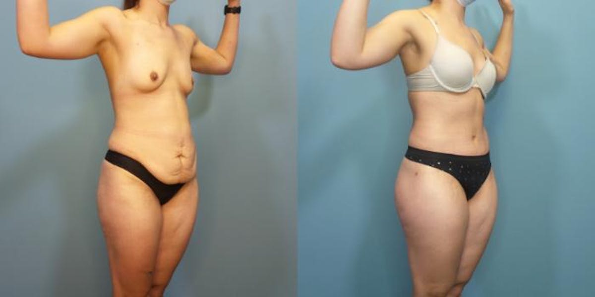 Massive Weight Loss/Body Lift Before & After Gallery - Patient 340220 - Image 2