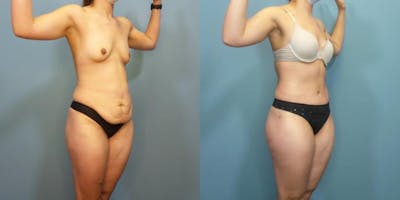 Massive Weight Loss/Body Lift Before & After Gallery - Patient 340220 - Image 2