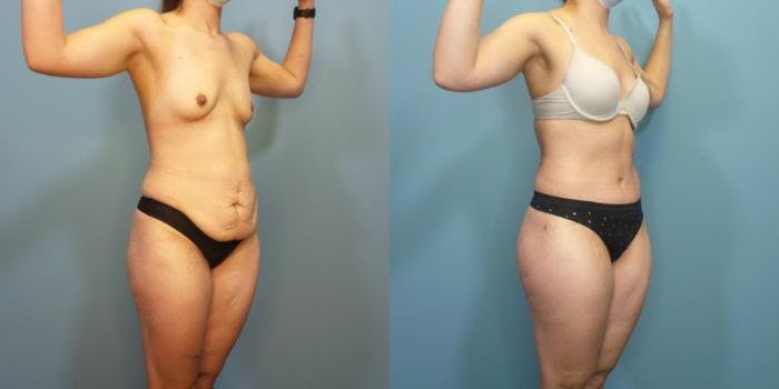 Massive Weight Loss/Body Lift Before & After Gallery - Patient 340220 - Image 2