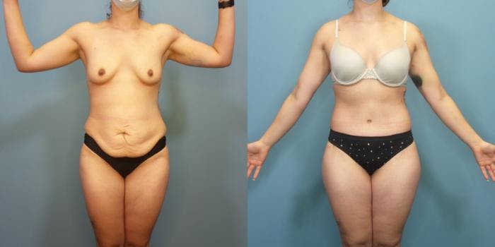 Massive Weight Loss/Body Lift Before & After Gallery - Patient 340220 - Image 3