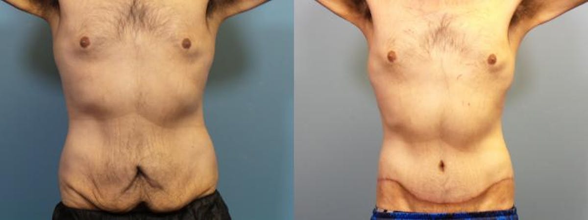 Massive Weight Loss/Body Lift Before & After Gallery - Patient 335055 - Image 1