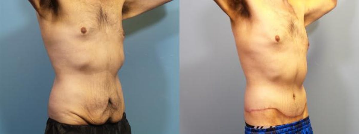 Massive Weight Loss/Body Lift Before & After Gallery - Patient 335055 - Image 2