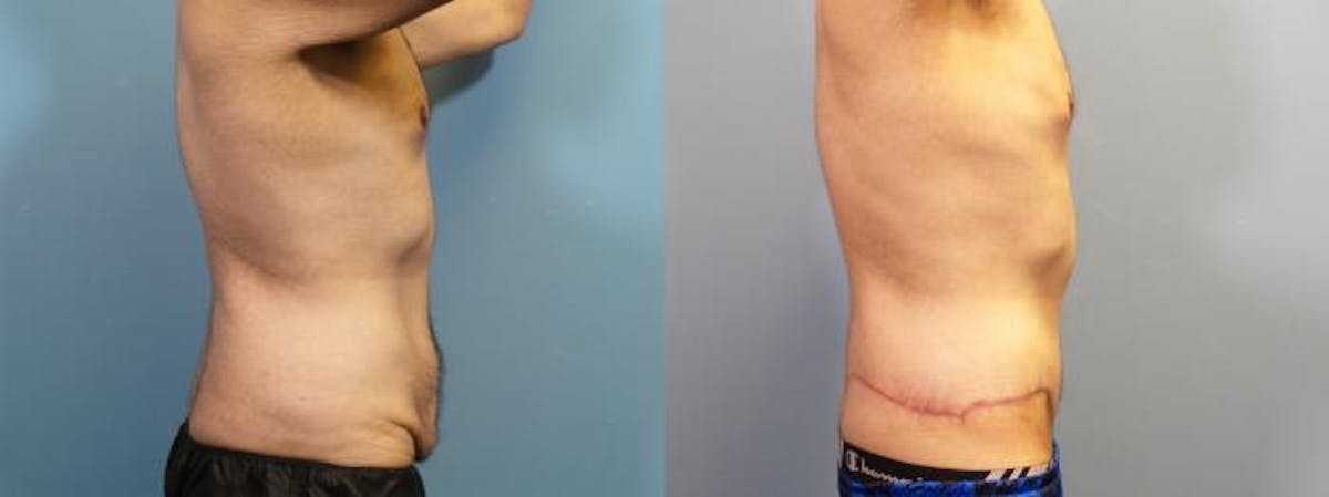 Massive Weight Loss/Body Lift Before & After Gallery - Patient 335055 - Image 3