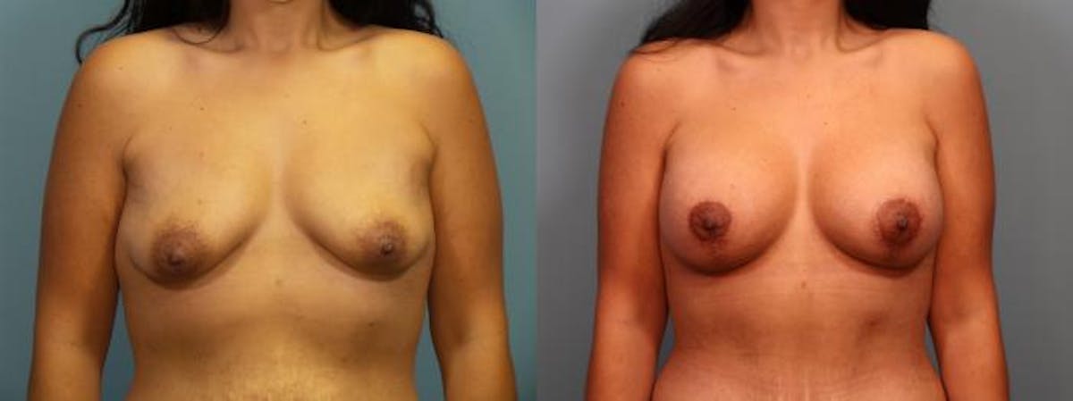 Massive Weight Loss/Body Lift Before & After Gallery - Patient 588276 - Image 1