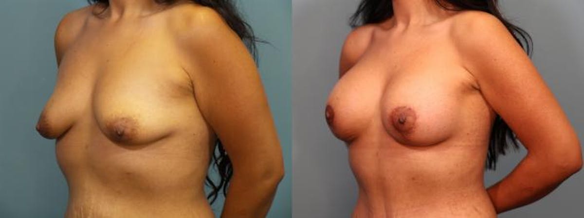 Massive Weight Loss/Body Lift Before & After Gallery - Patient 588276 - Image 2