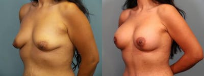 Massive Weight Loss/Body Lift Before & After Gallery - Patient 588276 - Image 2