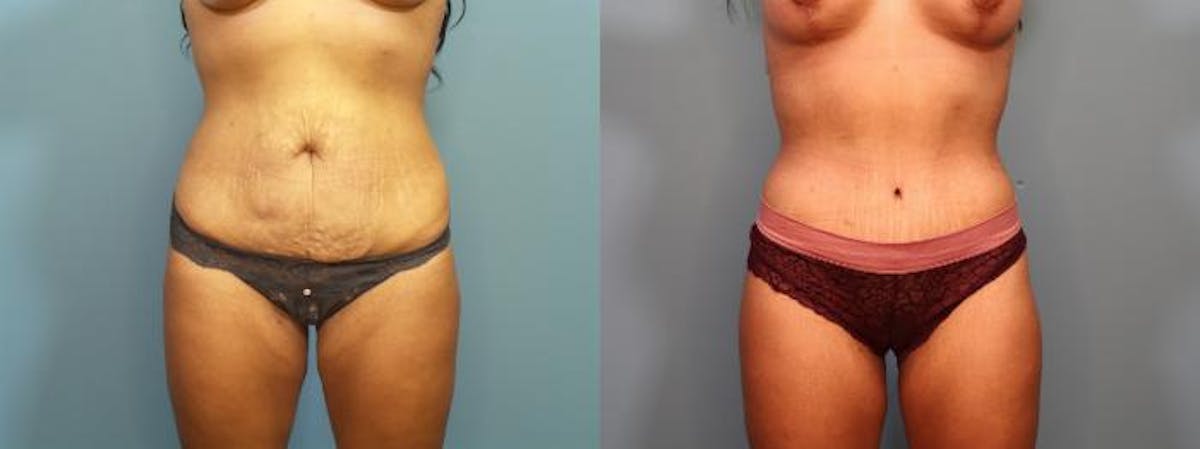 Massive Weight Loss/Body Lift Before & After Gallery - Patient 588276 - Image 3