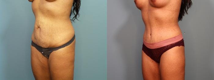 Massive Weight Loss/Body Lift Before & After Gallery - Patient 588276 - Image 4