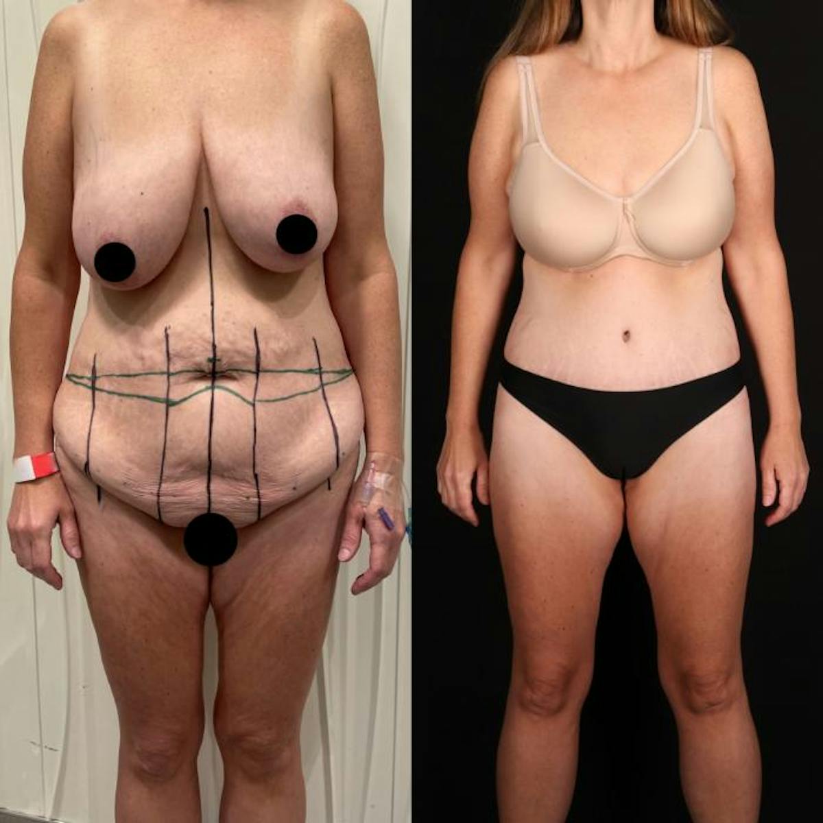 Massive Weight Loss/Body Lift Before & After Gallery - Patient 230479 - Image 1