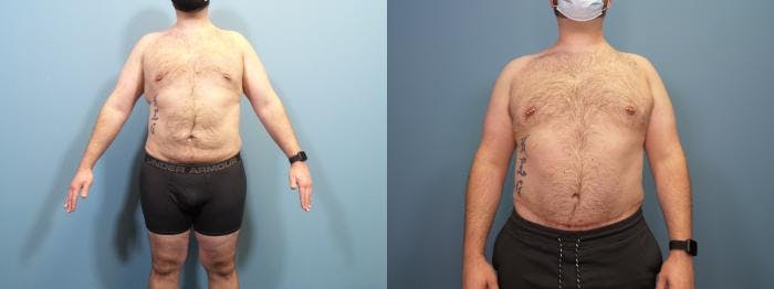 Massive Weight Loss/Body Lift Before & After Gallery - Patient 121166 - Image 1