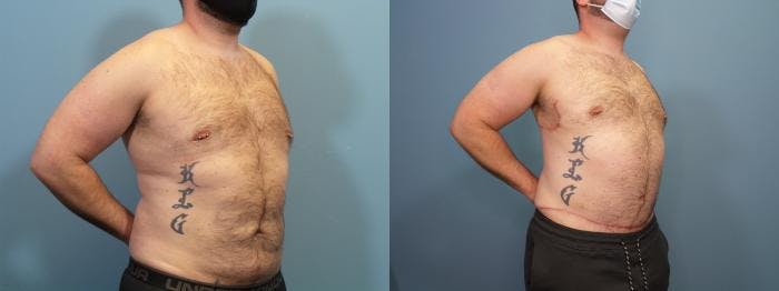 Massive Weight Loss/Body Lift Before & After Gallery - Patient 121166 - Image 2