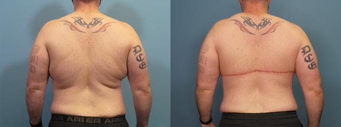 Massive Weight Loss/Body Lift Before & After Gallery - Patient 121166 - Image 3