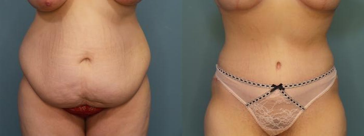 Massive Weight Loss/Body Lift Before & After Gallery - Patient 406468 - Image 1