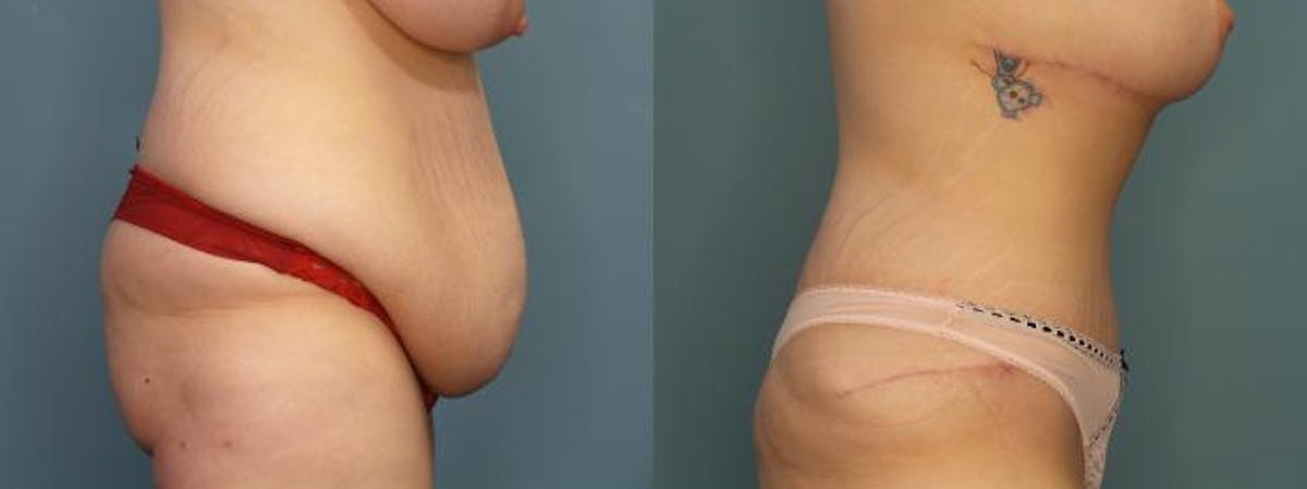 Massive Weight Loss/Body Lift Before & After Gallery - Patient 406468 - Image 2