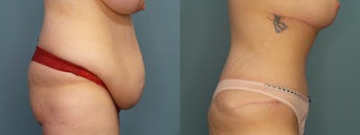 Massive Weight Loss/Body Lift Before & After Gallery - Patient 406468 - Image 2
