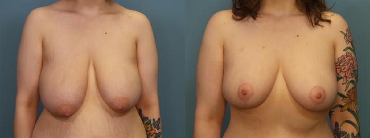 Massive Weight Loss/Body Lift Before & After Gallery - Patient 406468 - Image 3