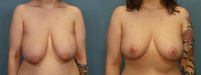Massive Weight Loss/Body Lift Before & After Gallery - Patient 406468 - Image 3