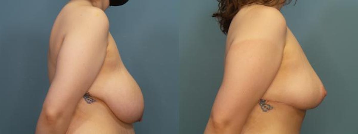 Massive Weight Loss/Body Lift Before & After Gallery - Patient 406468 - Image 5