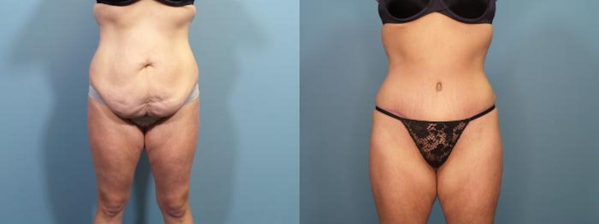 Massive Weight Loss/Body Lift Before & After Gallery - Patient 357768 - Image 1