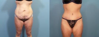 Massive Weight Loss/Body Lift Before & After Gallery - Patient 357768 - Image 1