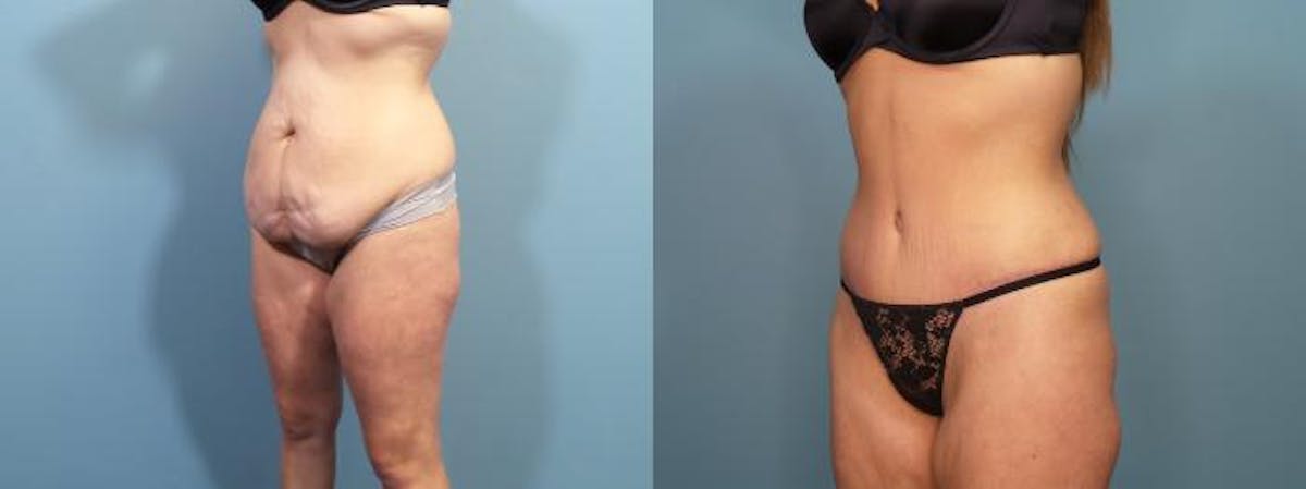 Massive Weight Loss/Body Lift Before & After Gallery - Patient 357768 - Image 2