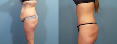 Massive Weight Loss/Body Lift Before & After Gallery - Patient 357768 - Image 3