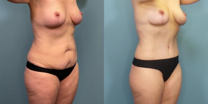 Massive Weight Loss/Body Lift Before & After Gallery - Patient 850675 - Image 1