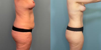 Massive Weight Loss/Body Lift Before & After Gallery - Patient 850675 - Image 2