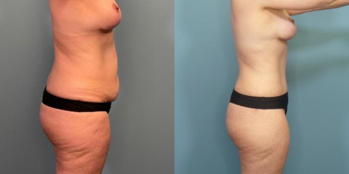 Massive Weight Loss/Body Lift Before & After Gallery - Patient 850675 - Image 2