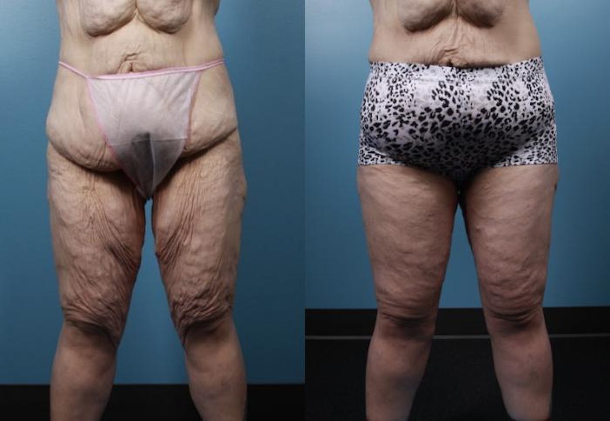 Massive Weight Loss/Body Lift Before & After Gallery - Patient 427819 - Image 1