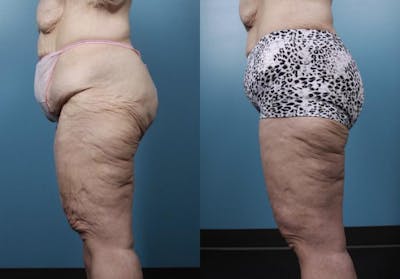 Massive Weight Loss/Body Lift Before & After Gallery - Patient 427819 - Image 2
