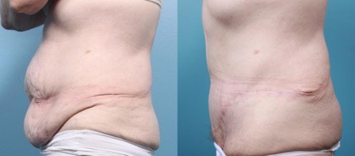 Massive Weight Loss/Body Lift Before & After Gallery - Patient 248104 - Image 1