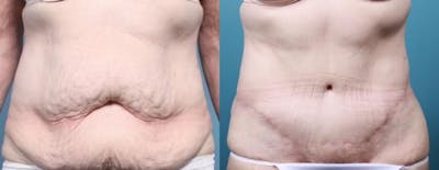 Massive Weight Loss/Body Lift Before & After Gallery - Patient 248104 - Image 2