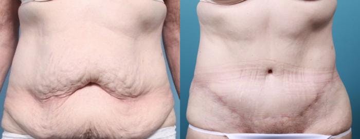 Massive Weight Loss/Body Lift Before & After Gallery - Patient 248104 - Image 2