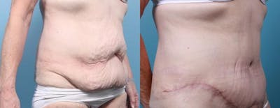Massive Weight Loss/Body Lift Before & After Gallery - Patient 248104 - Image 3