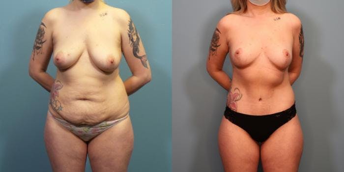 Massive Weight Loss/Body Lift Before & After Gallery - Patient 137190 - Image 1