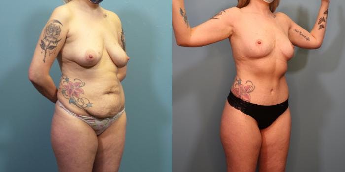 Massive Weight Loss/Body Lift Before & After Gallery - Patient 137190 - Image 2