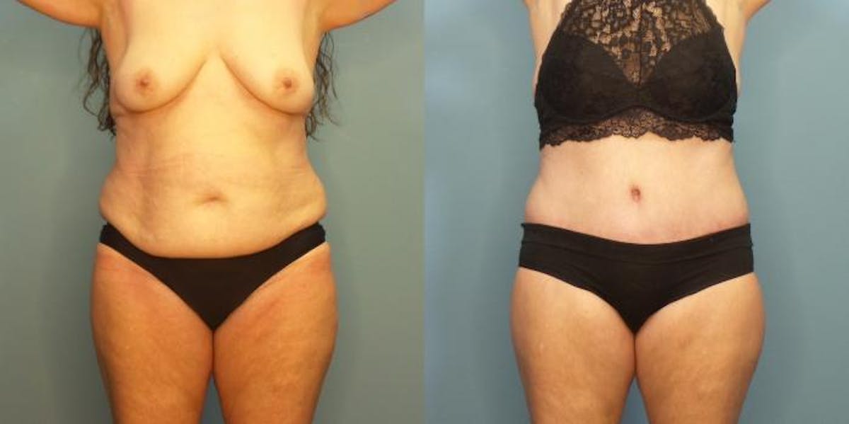 Massive Weight Loss/Body Lift Before & After Gallery - Patient 281551 - Image 1