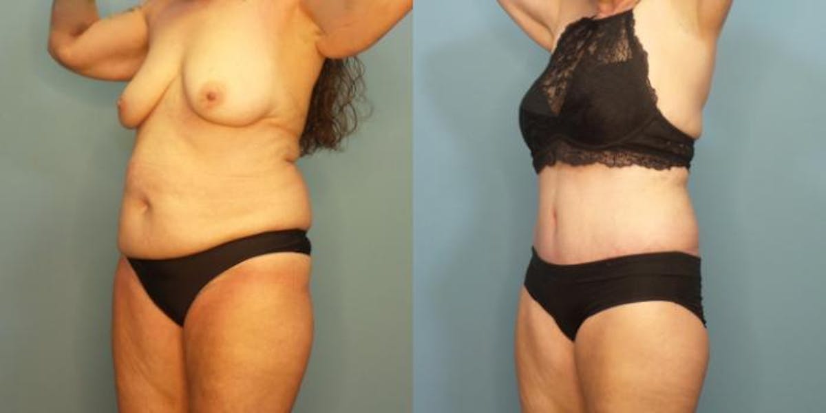 Massive Weight Loss/Body Lift Before & After Gallery - Patient 281551 - Image 2