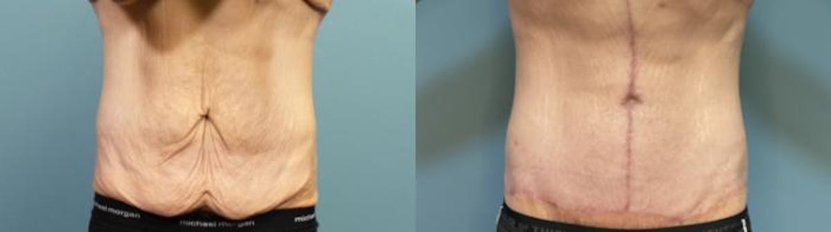Massive Weight Loss/Body Lift Before & After Gallery - Patient 101994 - Image 1