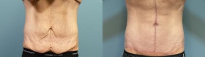 Massive Weight Loss/Body Lift Before & After Gallery - Patient 101994 - Image 1