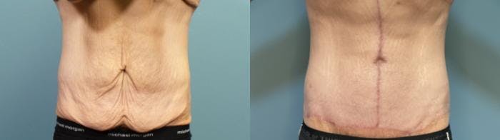 Massive Weight Loss/Body Lift Before & After Gallery - Patient 101994 - Image 1
